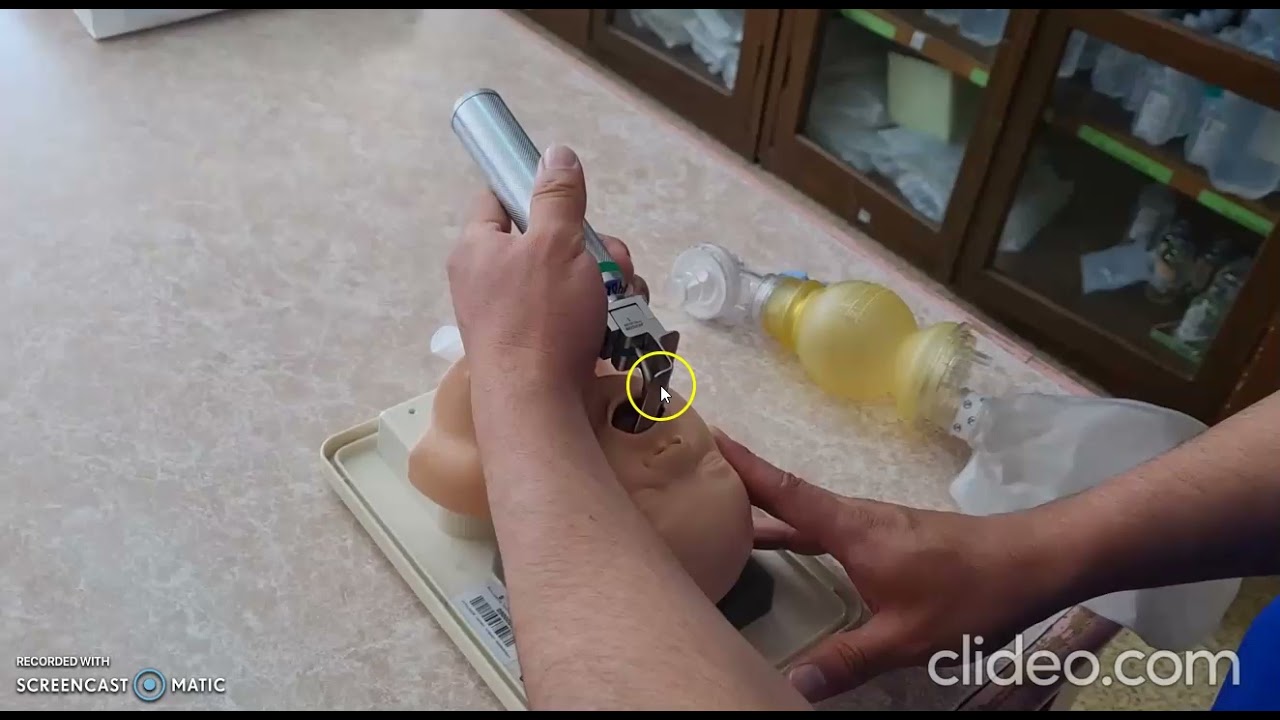 Intubación endotraqueal neonatal