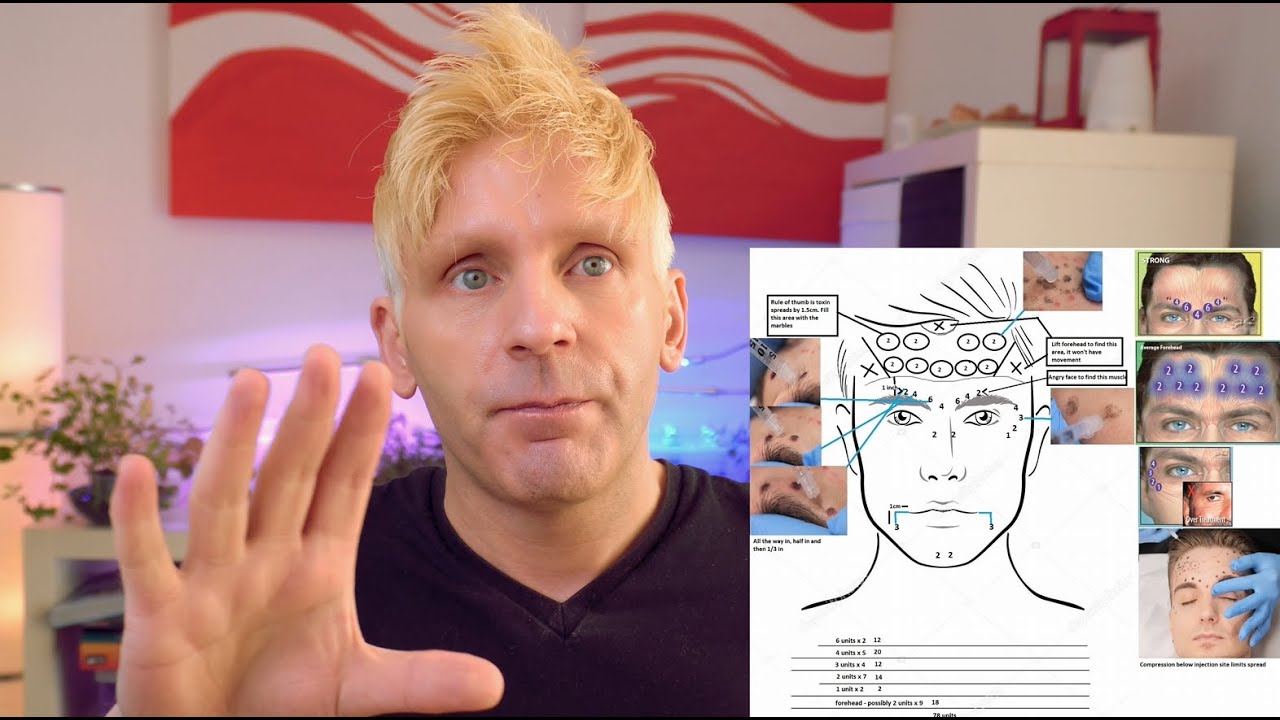 DIY Botox at home - Botulinum Toxin injection points