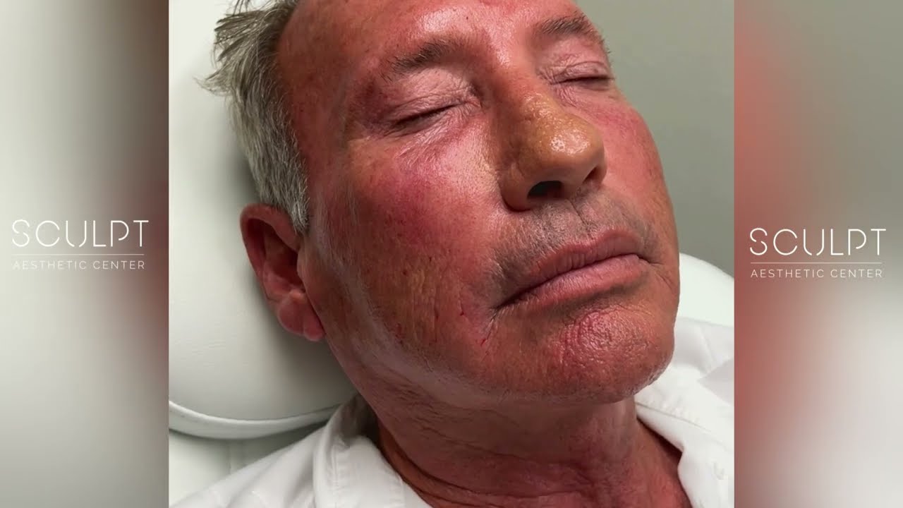 Cellenis PRP NEW Natural Skin Treatment | Sculpt Center