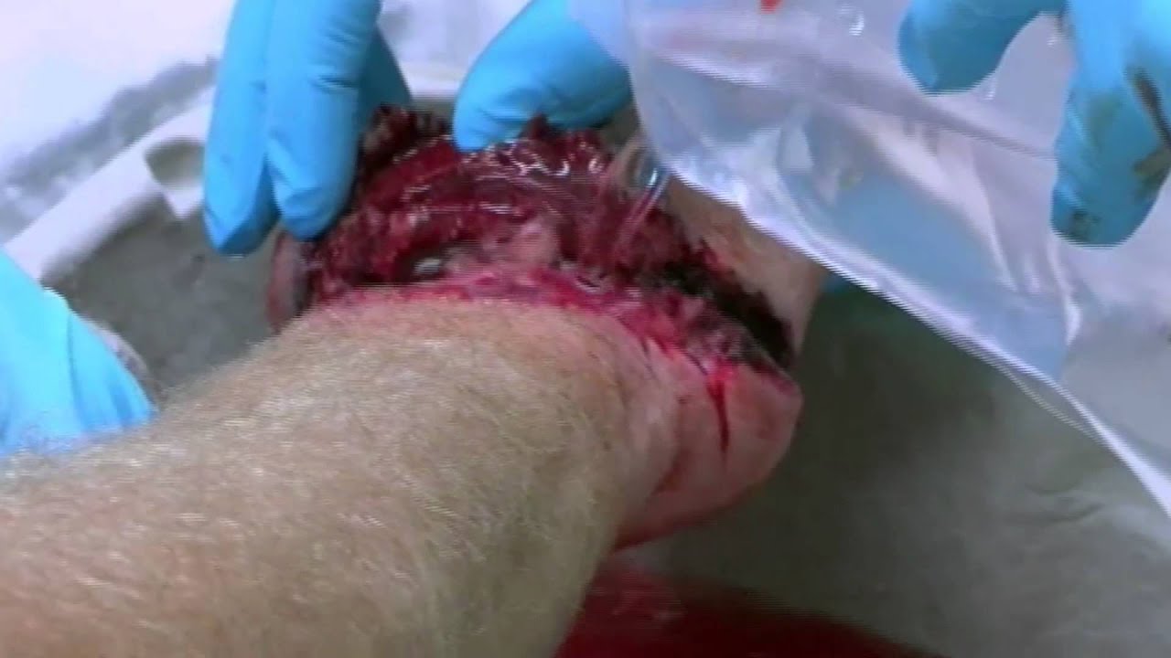 Hand Almost Sliced Off - Bizarre ER