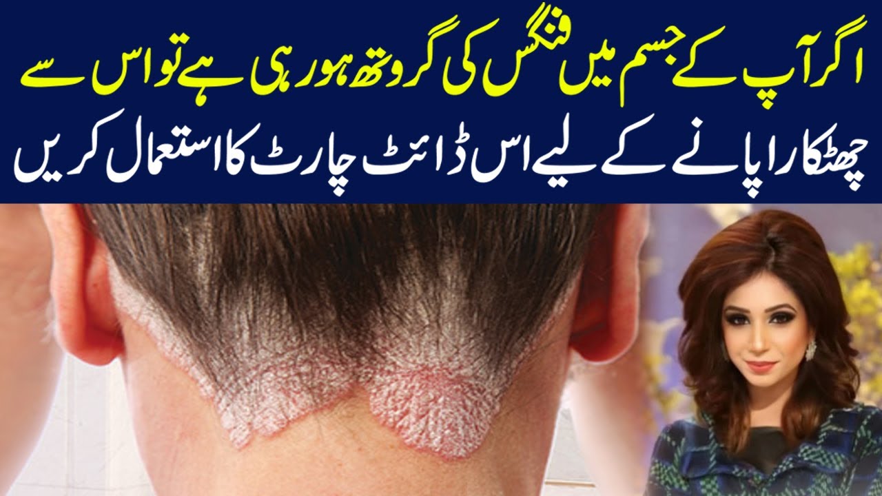 Diet chart to get rid of fungus from your body | Dr Sahar Chawla