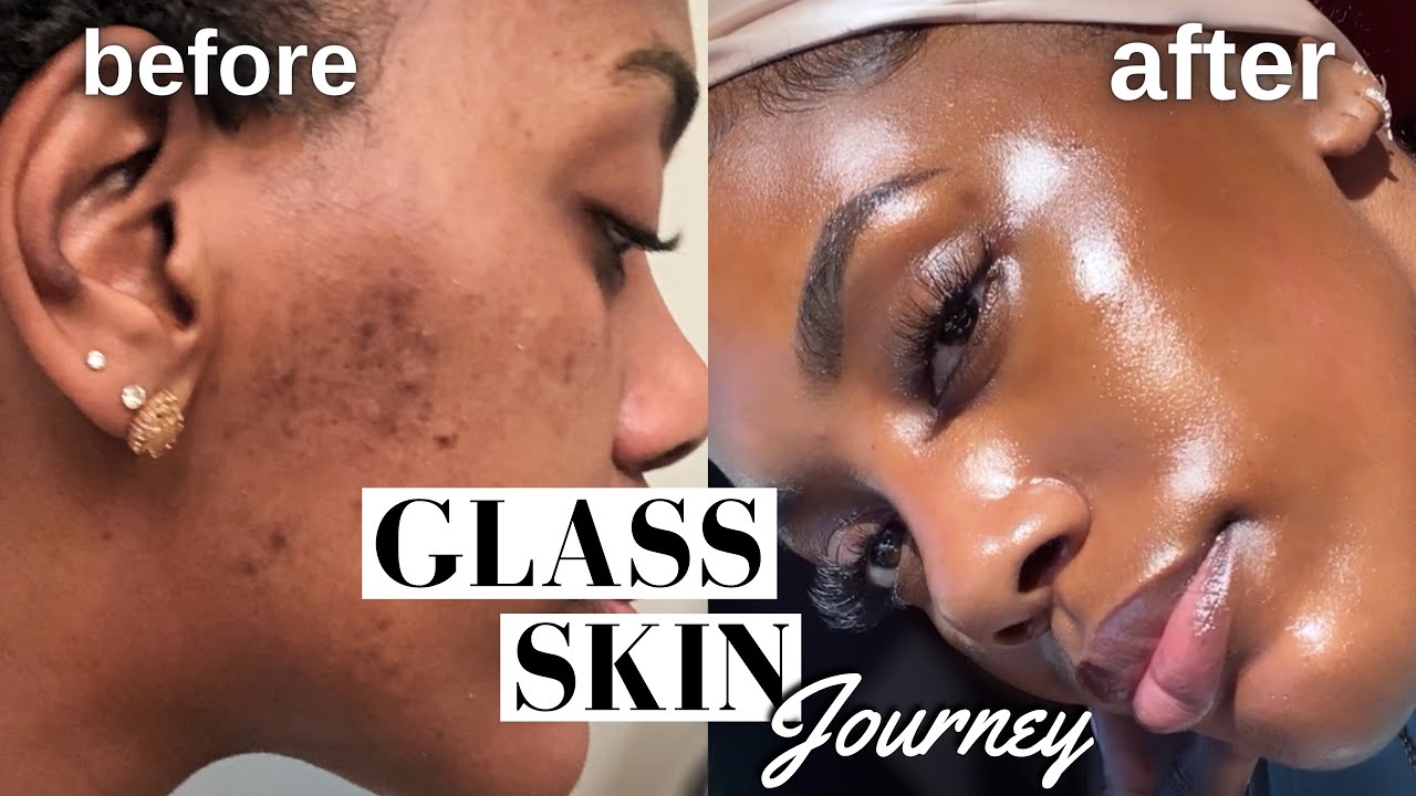 КАК Я ИЗБАВИЛАСЬ ОТ ГИПЕРПИГМЕНТАЦИИ, АКНЕ И ТЕМНЫХ ПЯТЕН!! | ПРОЦЕДУРА GLASS SKIN *ОБЯЗАТЕЛЬНО К...