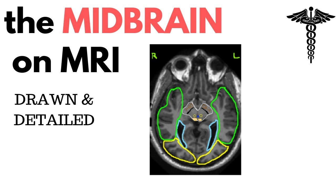 Neuroanatomy on MRI Part 2 | Hypothalamus & Midbrain tectum, tegmentum & floor