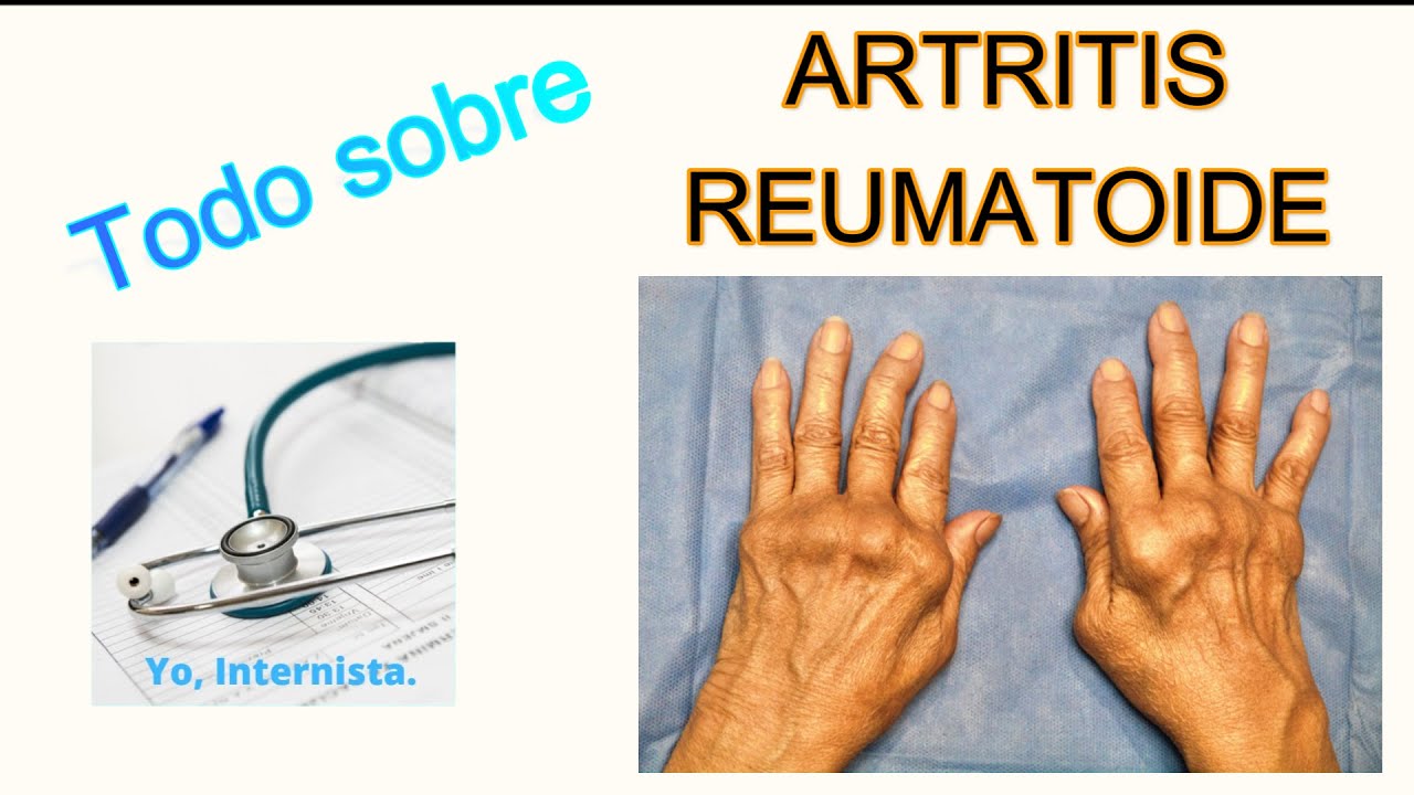 TODO SOBRE ARTRITIS REUMATOIDE. ESPECIAL PACIENTE