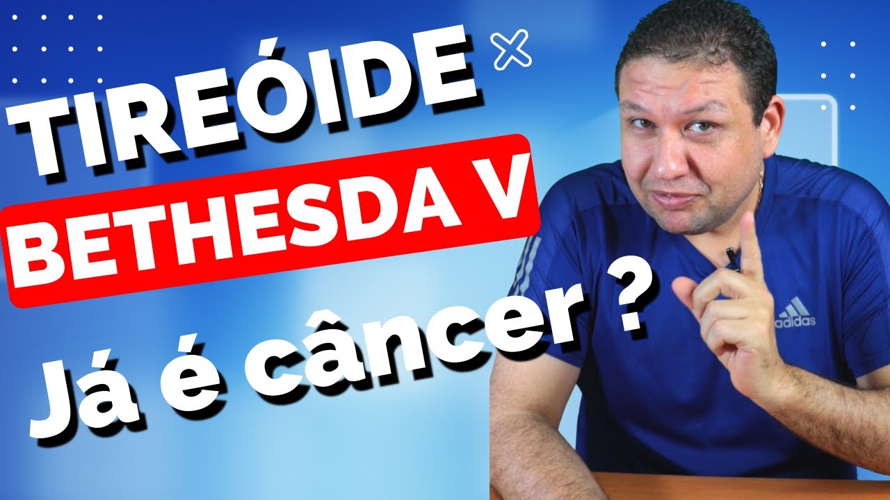 Nódulo de tireóide BETHESDA V, CATEGORIA 5, nódulo de tireóide suspeito para câncer de tireóide.