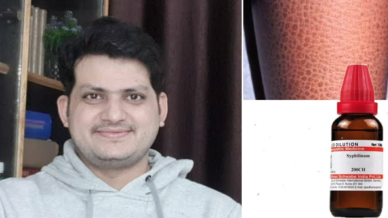 | Syphilinum for Ichthyosis | Dr.kirti vikram Singh LIVE CLINIC #1194 17/11/2020