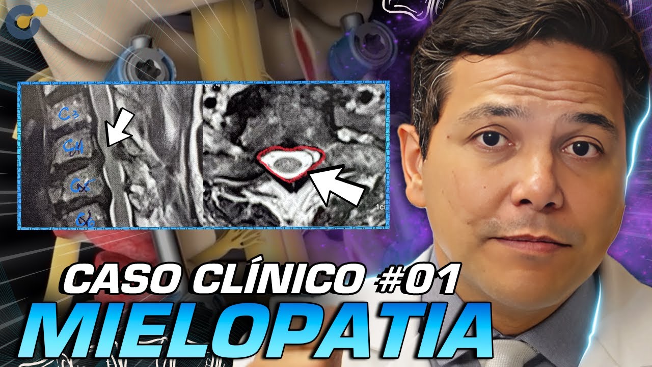 Caso Clínico: Mielopatia – Do Diagnóstico até a Cirurgia