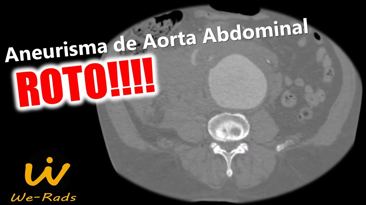 Aneurisma de Aorta Abdominal Roto na Tomografia