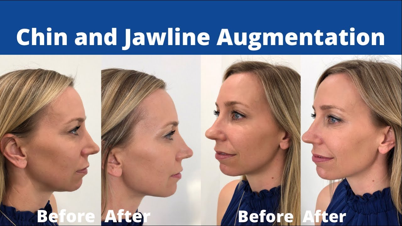 Chin and Jawline Augmentation with Dermal Fillers