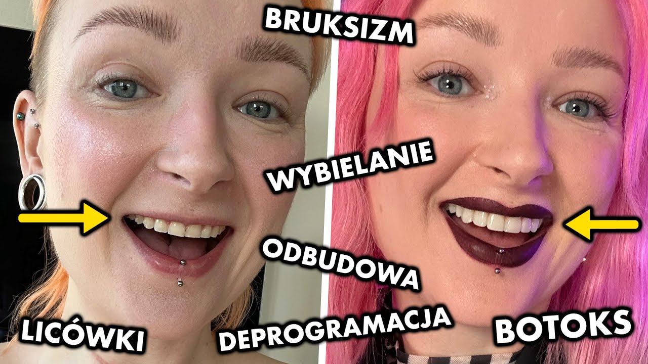 Moje nowe zęby - Bruksizm, prostowanie nakładkami, estetyka