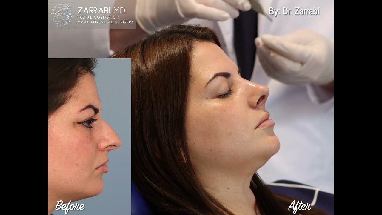 Closed Piezo Rhinoplasty