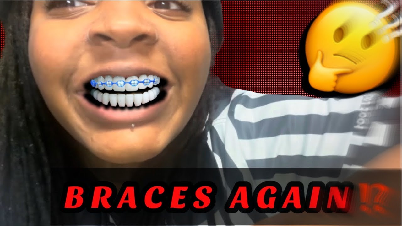 BRACES AGAIN| REPAIR THE NEXT DAY| PERFECT 😀FOR THE BIG DAY| WILL I HET VENEERS❓❓
