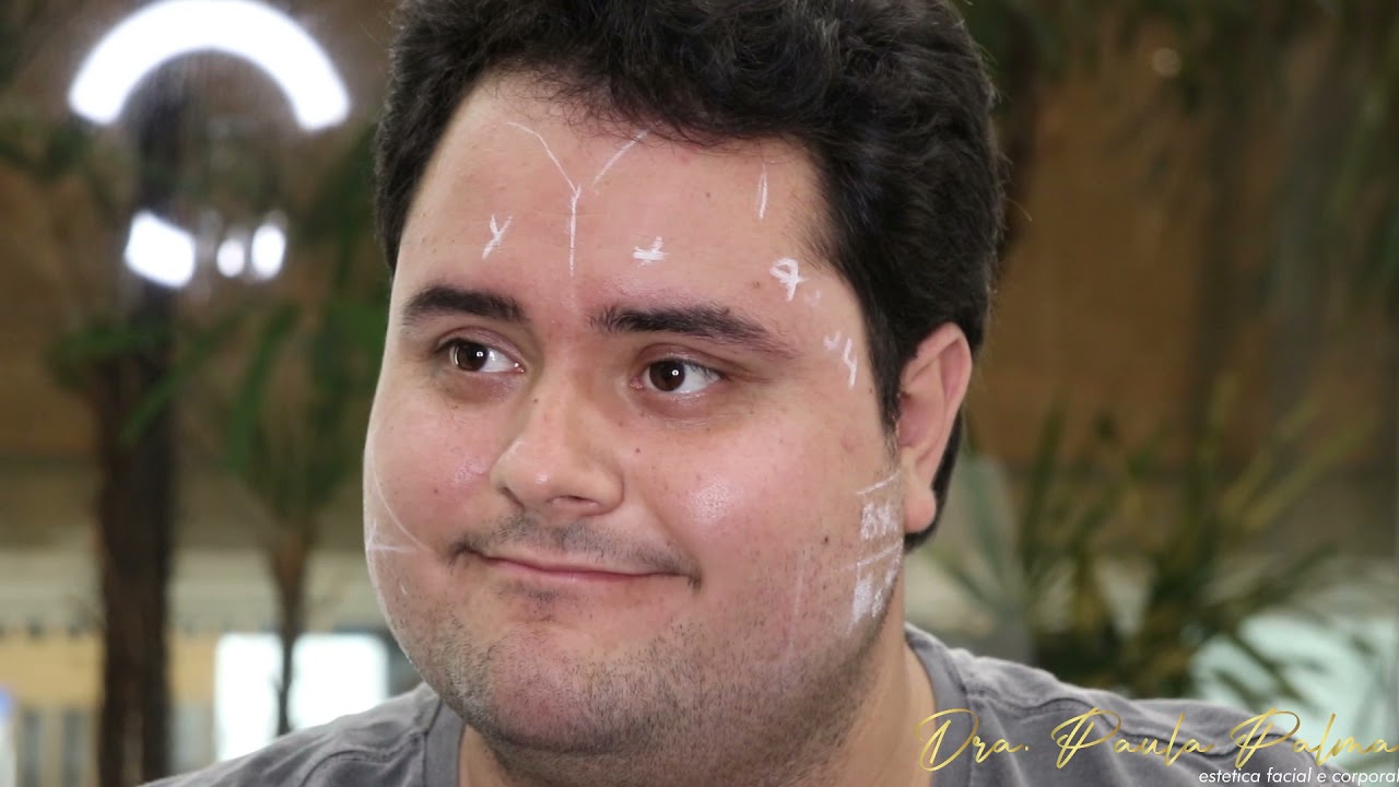 Avaliação de Botox em Masseter para bruxismo!
