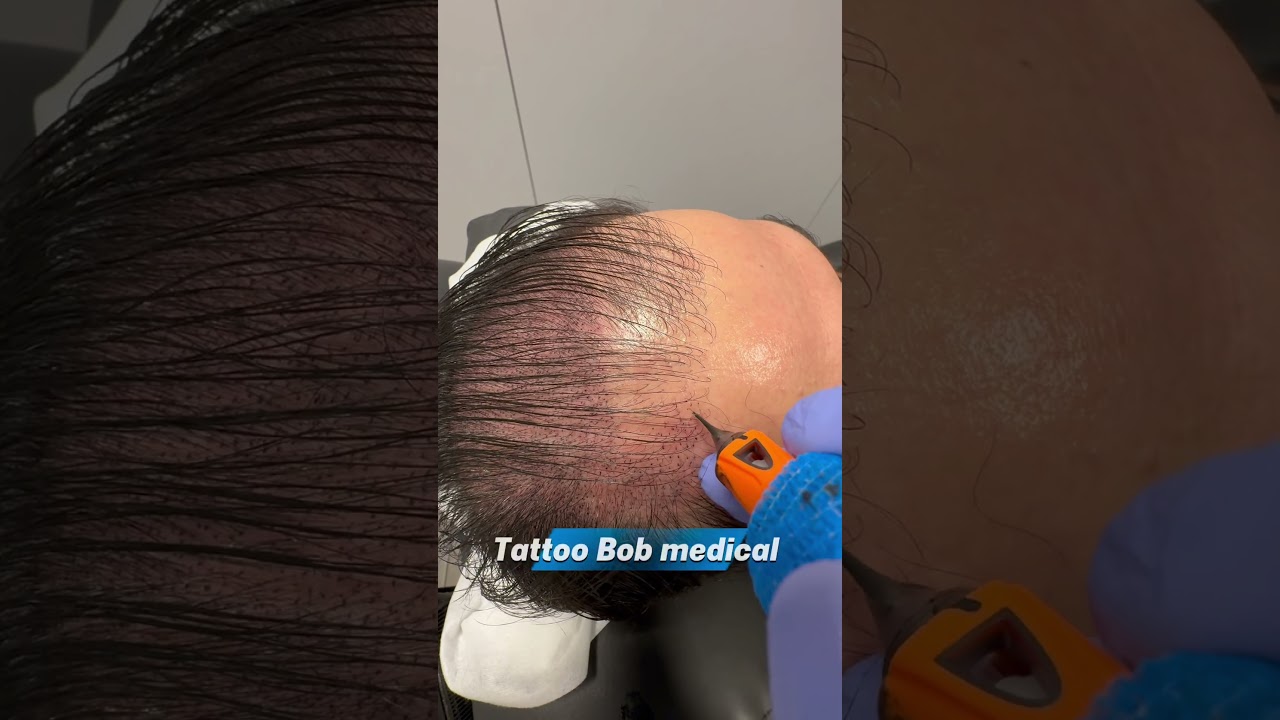 Nooit meer kaal!!! #kaalheid #alopecianederland #alopecia #dunhaar #haarlijn #microhaarpigmentatie