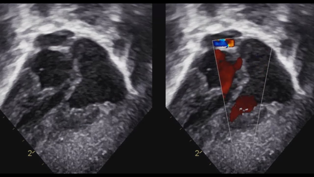 Case 8 " Pediatric Echo Quizzes Series "
