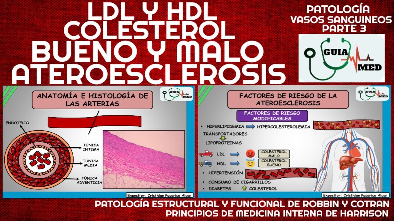 ATEROESCLEROSIS Y ARTERIOESCLEROSIS | GuiaMed