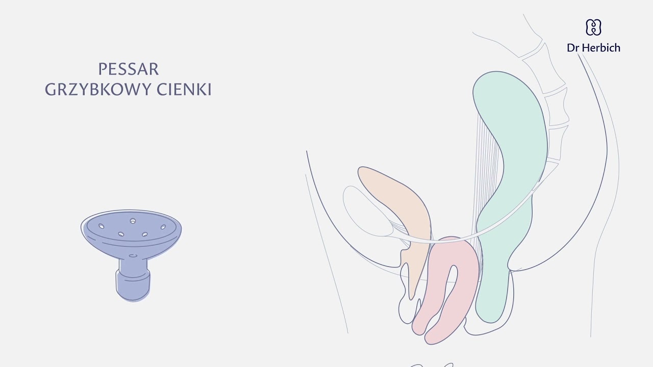 Jak działa pessar grzybkowy cienki przy wypadaniu macicy?