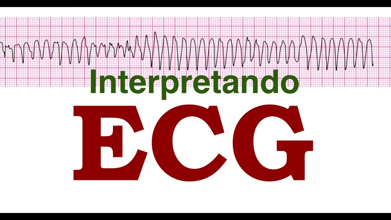 Interpretando ECG
