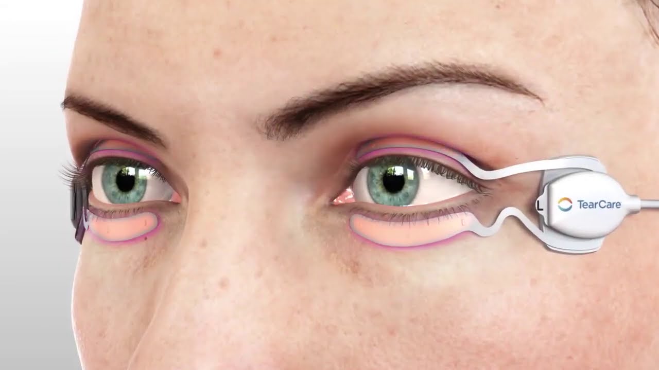 Golden Vision Dry Eye Center: TearCare Advance Dry Eye Treatmen