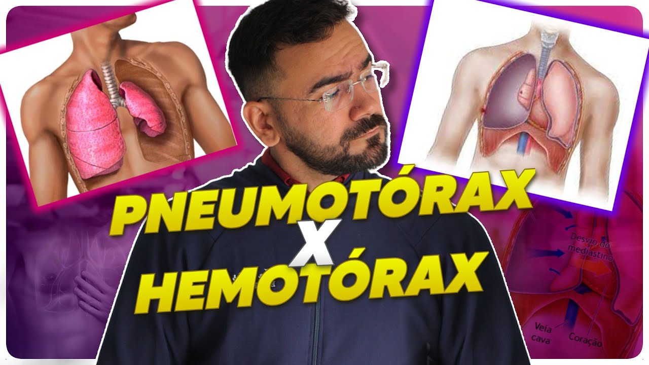 PNEUMOT&Oacute;RAX E HEMOT&Oacute;RAX: QUAL A DIFEREN&Ccedil;A ENTRE ELES DOIS? - URGENCIA E EMERG&Ecirc;NCIA