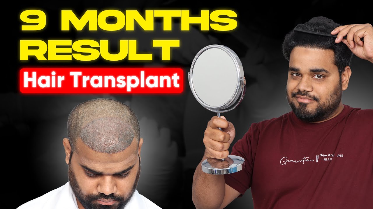 Hair Transplant in Noida (HX-NTRQ) | Best Results & Cost of Hair Transplant in Noida