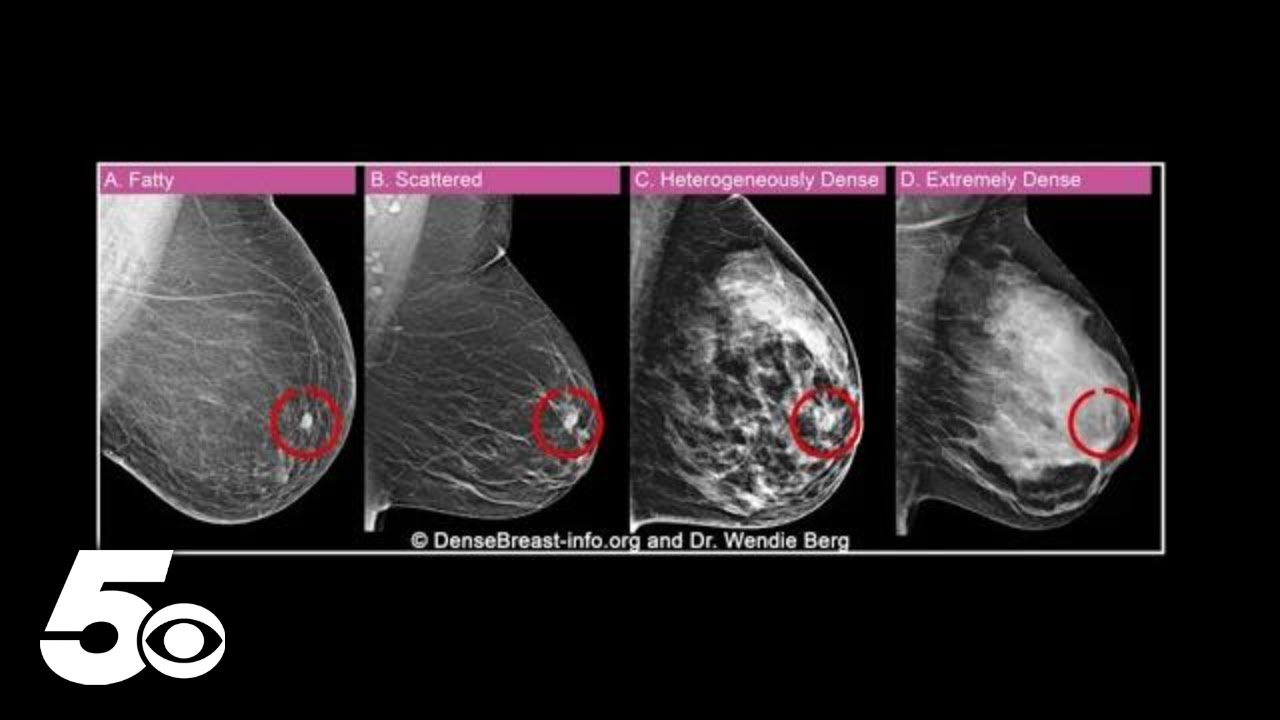 How dense breasts can be a higher cancer risk for women
