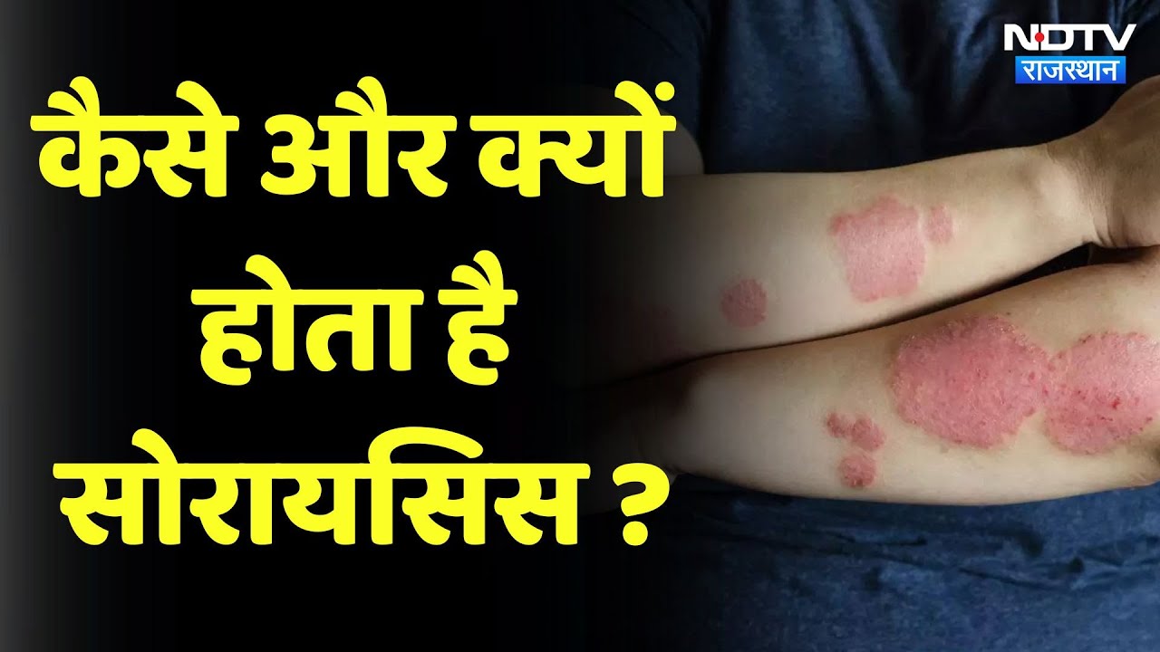 Sehat Ki Pathshala: Psoriasis के क्या हैं कारण और लक्षण, एसे करें बचाव | Treatment | Skin Disease