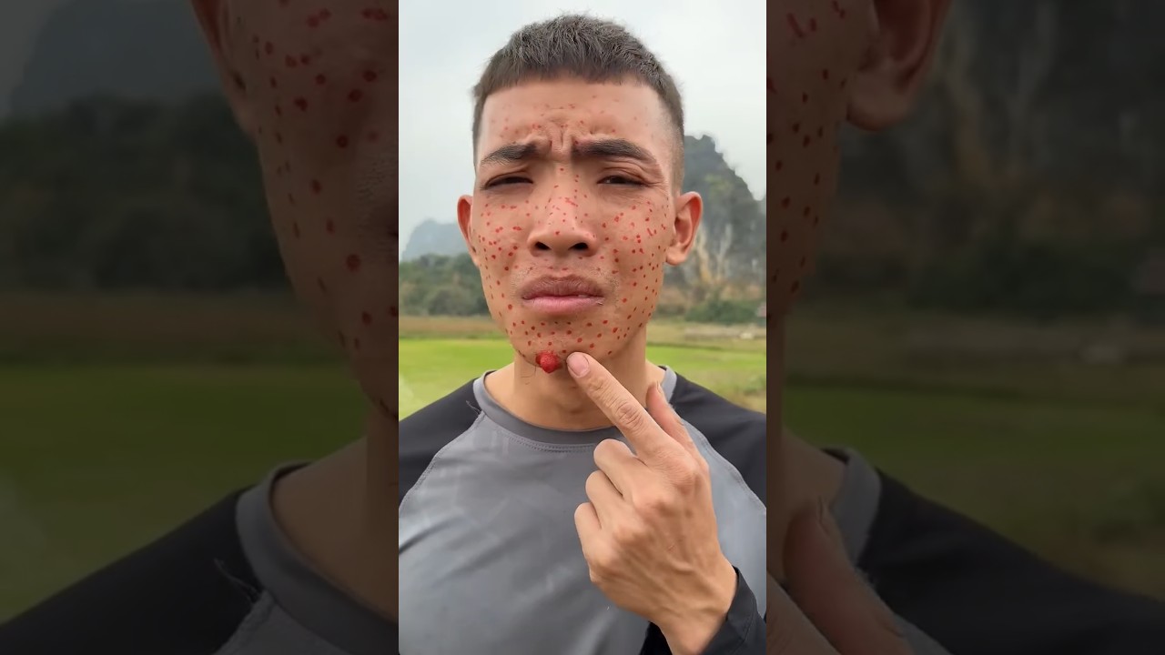 How I Used Cow Manure to Treat Acne in theWild | Survival Story