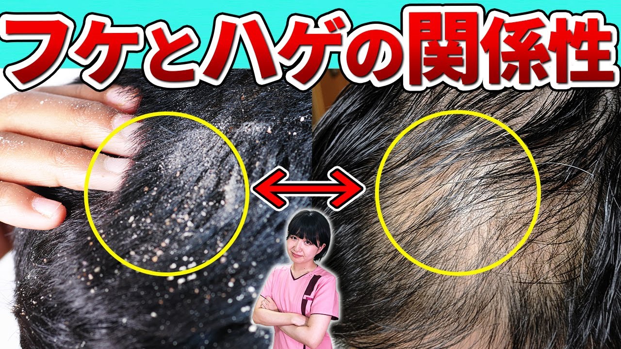 【この時期要注意】フケはハゲにつながるのかプロが解説