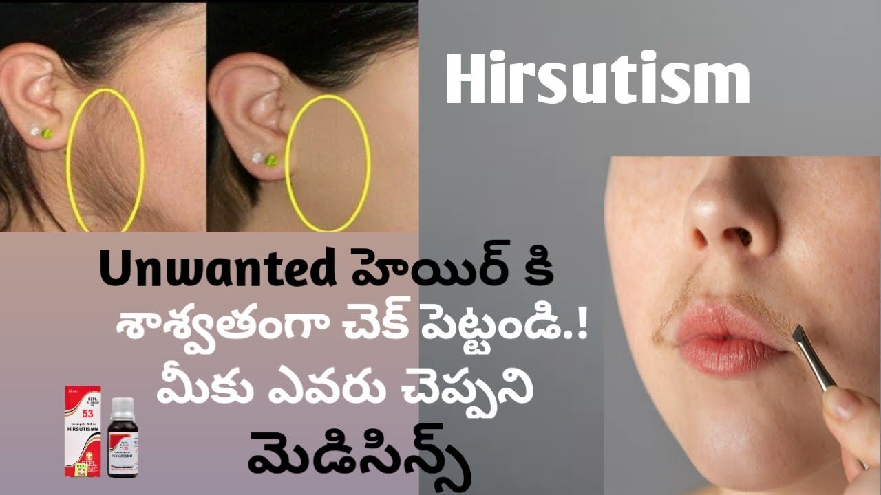 Effective Homeo medicines for unwanted hair in telugu||Hirsutism treatment by Dr.jai kishore.