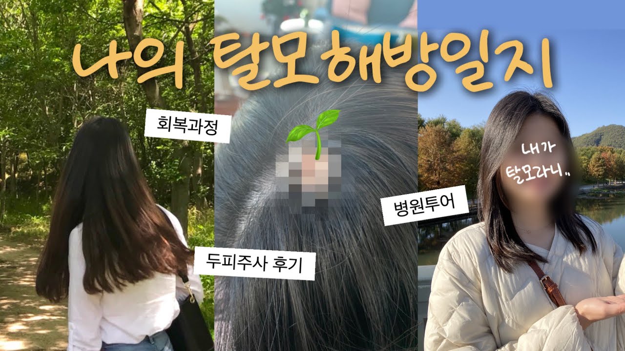 풍성했던 나의 탈모 해방일지📝/ 20대 여자 원형탈모 후기, 극복방법, 탈모병원, 탈모치료 추천
