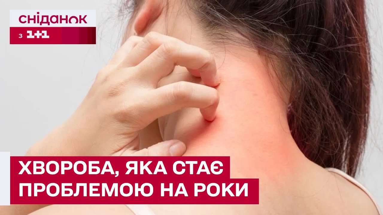 Ця хвороба робить життя нестерпним! Що потрібно знати про атопічний дерматит?