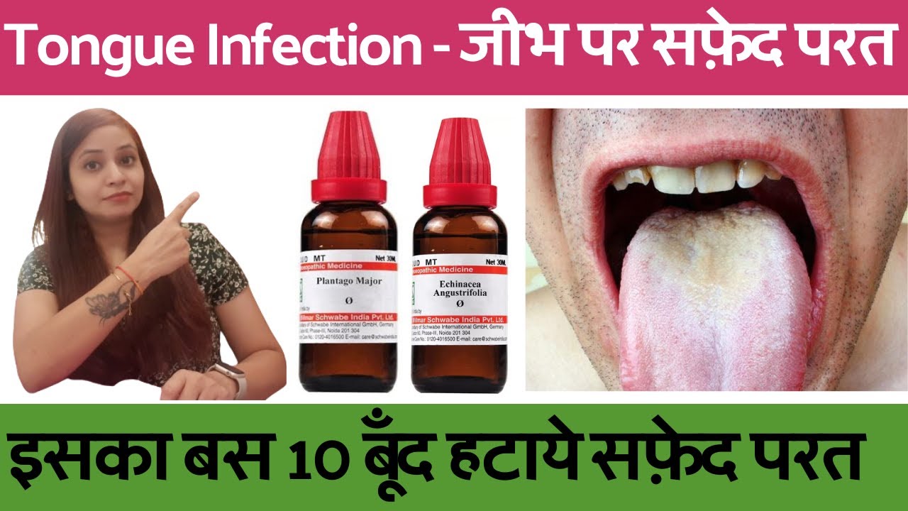 जीभ पर सफ़ेद परत जमने का कारण और ईलाज | white tongue causes & treatment | tongue fungal infection