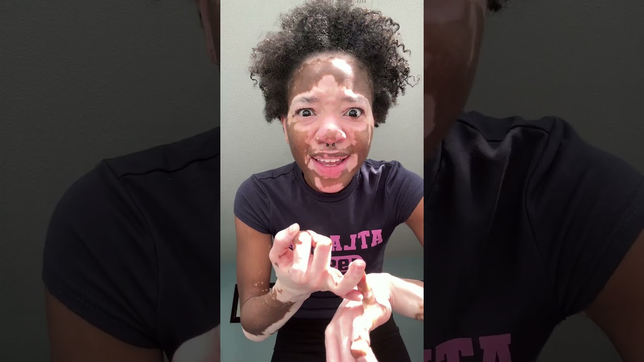 I&rsquo;m TIRED OF THIS GRANPAAAAA 🤬 | #explore #vitiligo #atlhairstylists