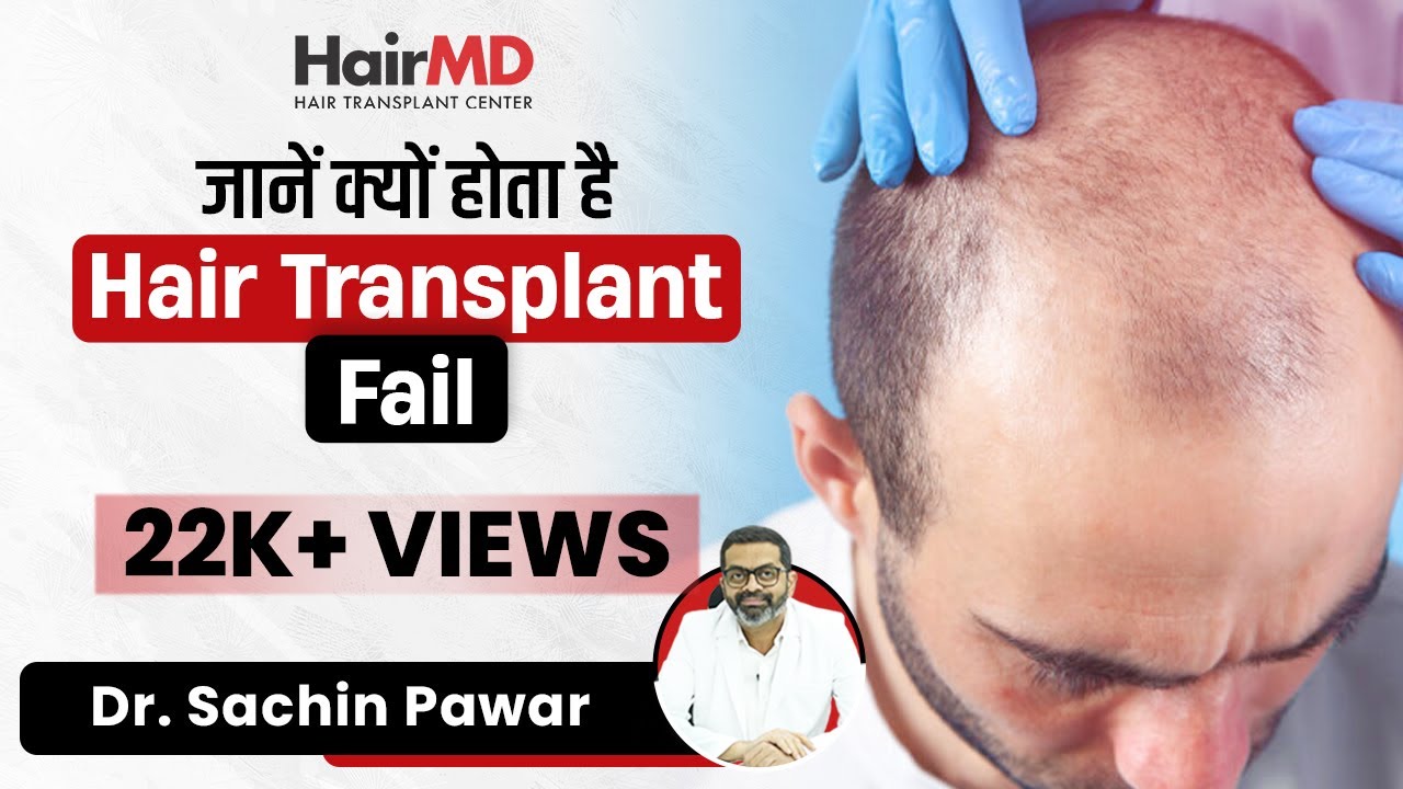 Hair Transplant Fail क्यों होता है? 6 Reasons Why Hair Transplant Fail? | HairMD, Pune