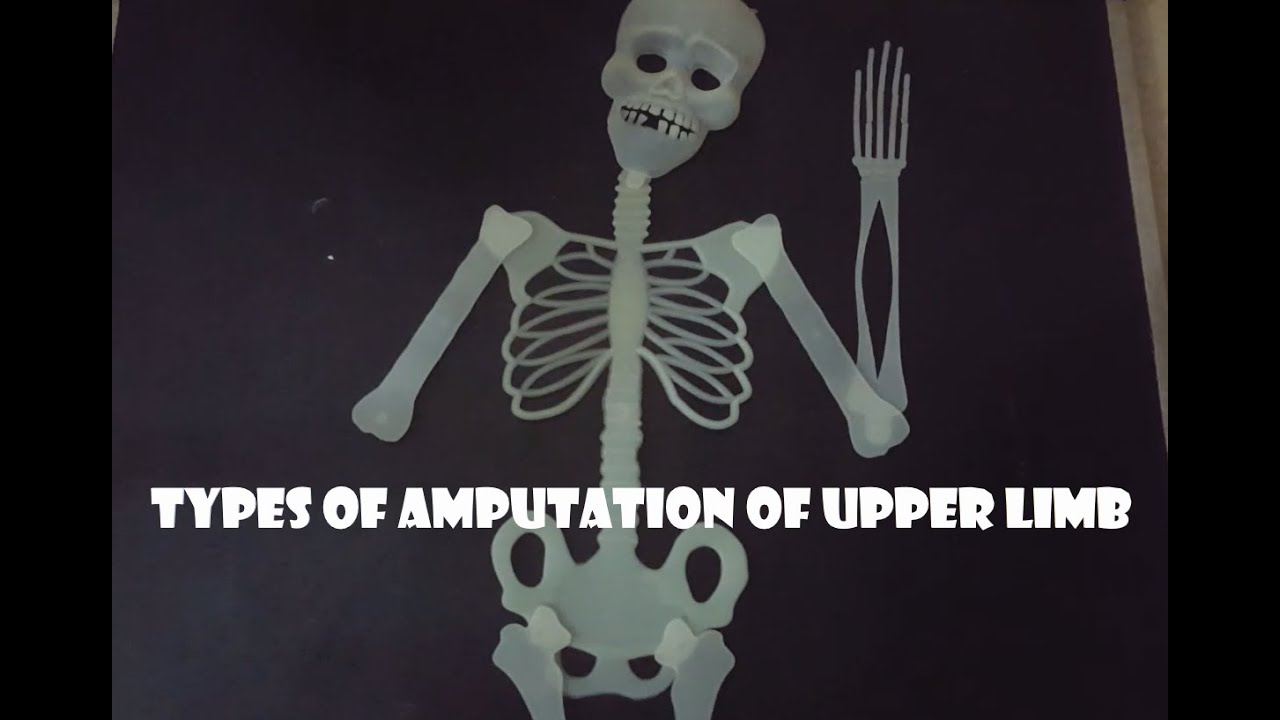 Upper limb amputation types