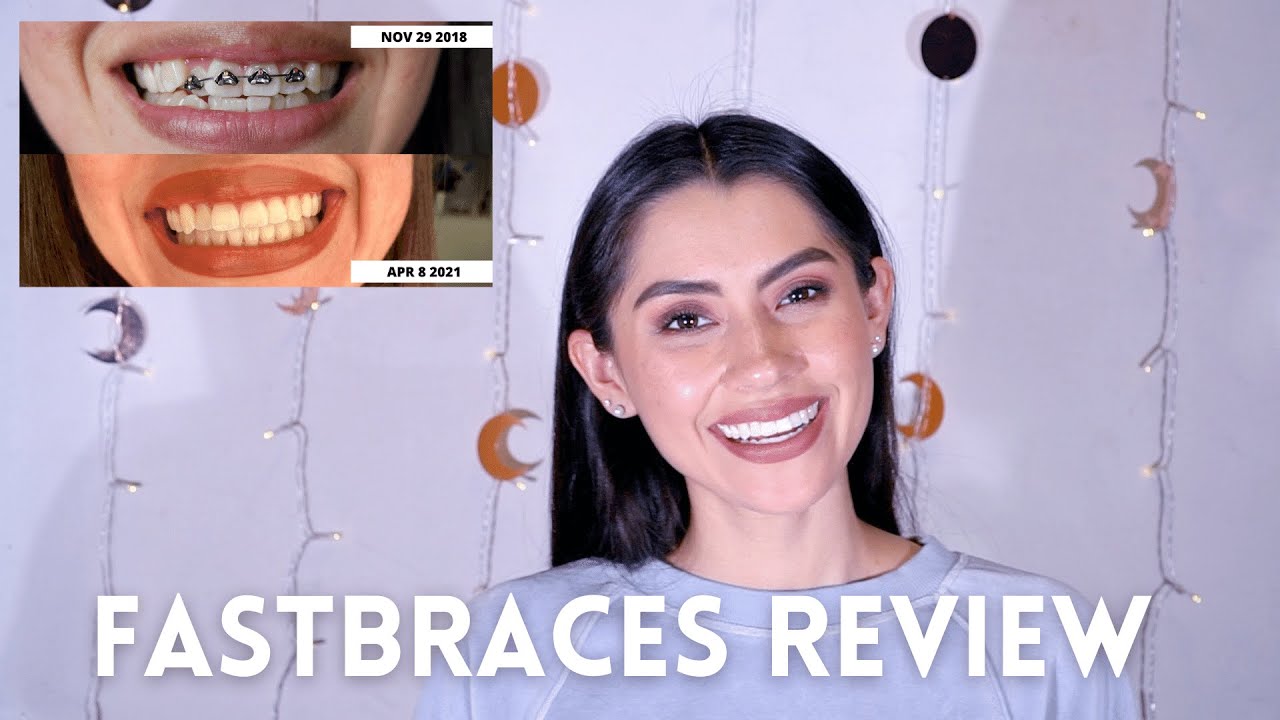 Fastbraces In Depth Review + Time lapse, Cost, & Process