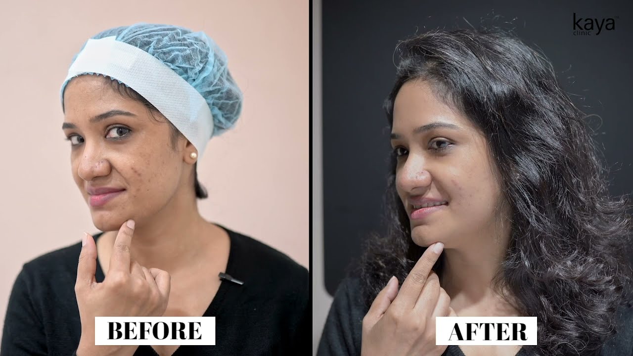 Kaya Q-Switch | Pigmentation Reduction | Treatment for Acne Scars