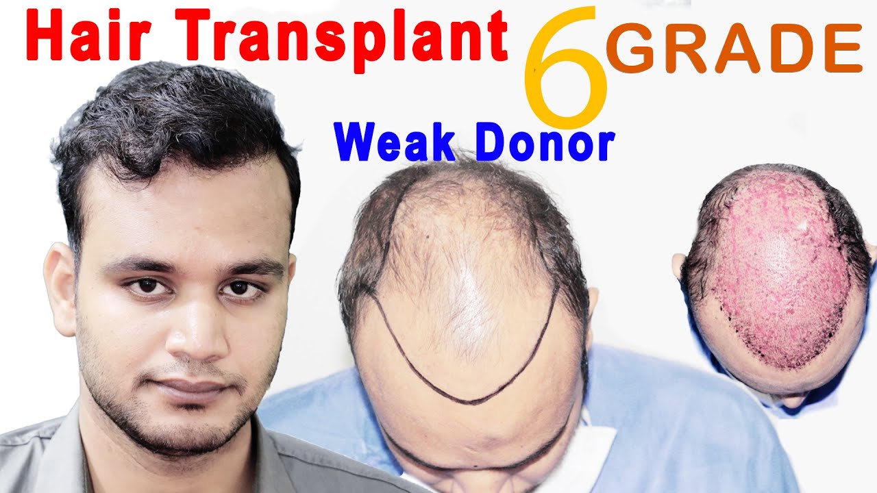Hair Transplant Result in India | Grade 6 | Weak Donor Area | Medispa | Dr Suneet Soni