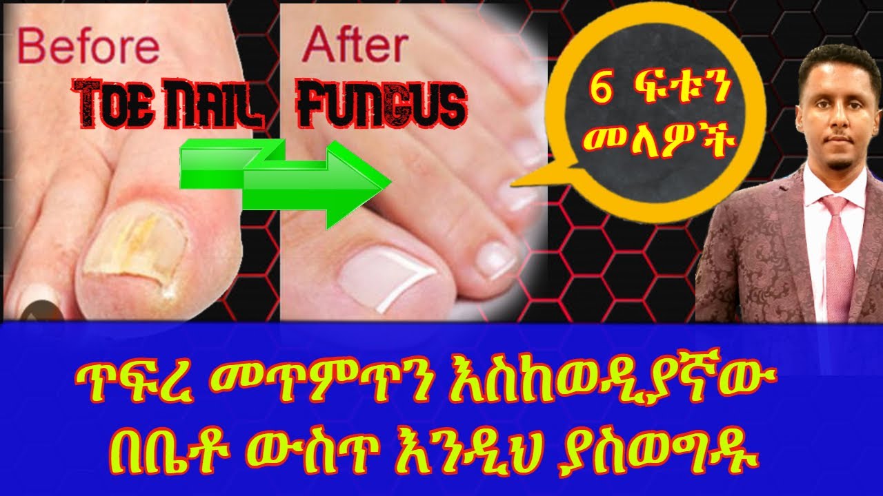 ETHIOPIA | ጥፍረ መጥምጥን እስከወዲያኛው በቤቶ ውስጥ እንዲህ ያስወግዱ / 6 ፍቱን መላዎች
