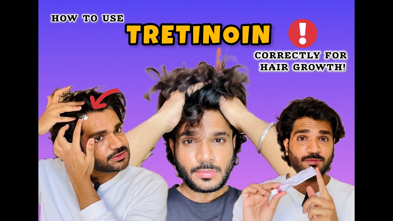 Correct Way to use Tretinoin for Hair Growth without Any Side Effects | Suraj Mathkar