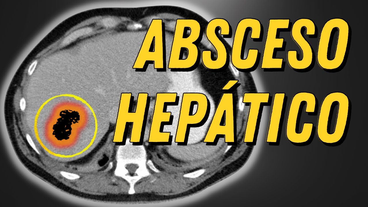 Absceso Hepático Explicado Claramente