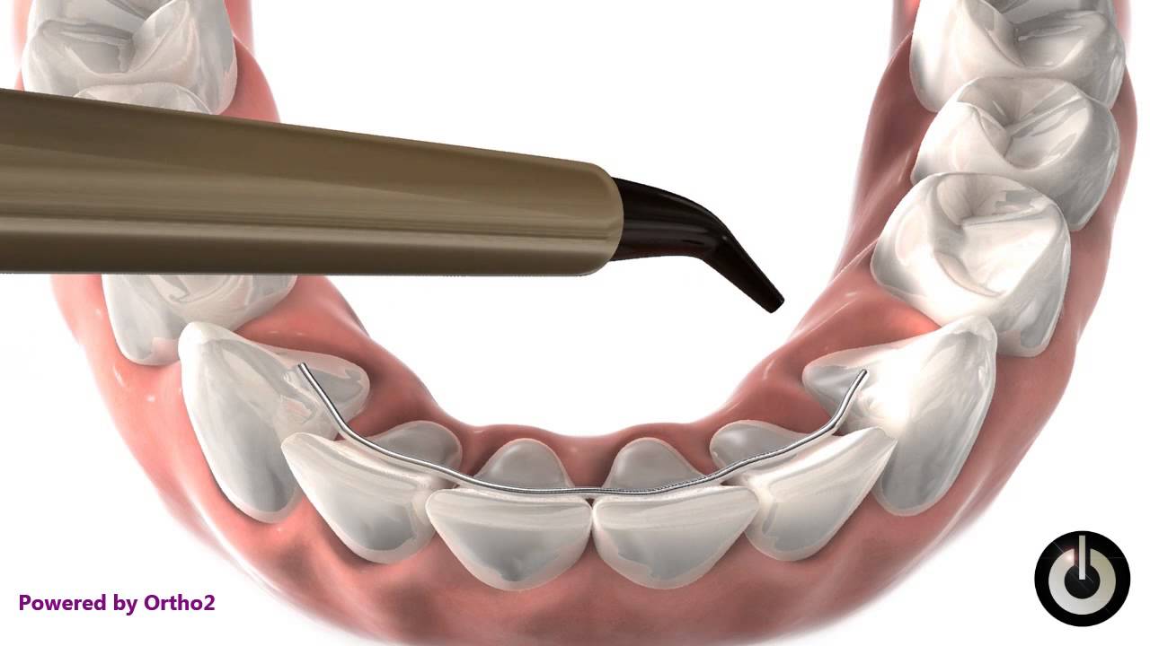 Bonded Retainer x 2
