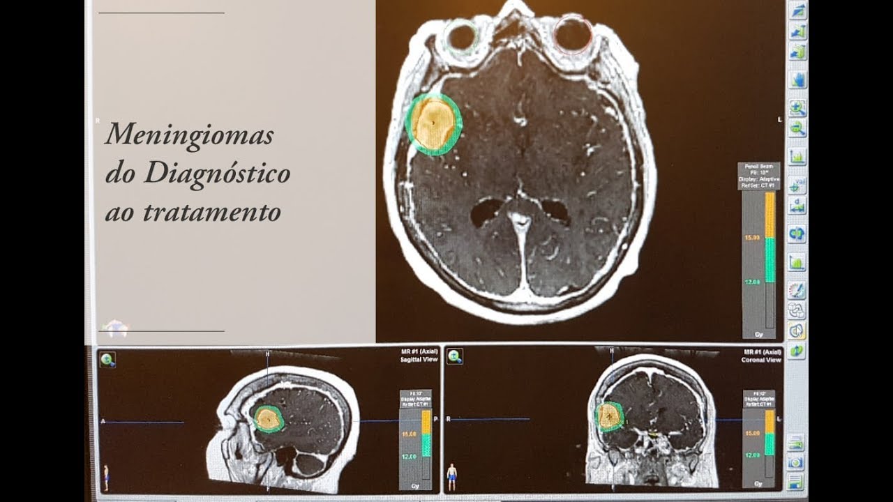 Meningioma - Visão Geral