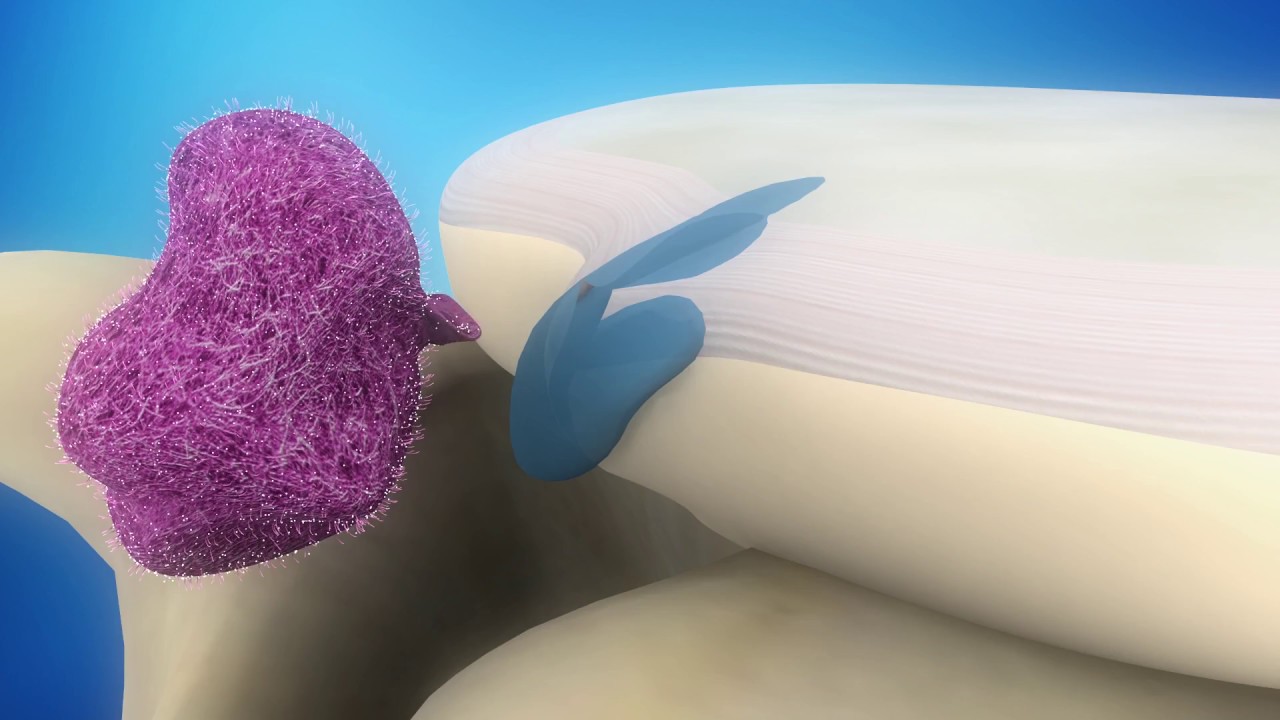 Mechanism of Healing Following a Disc Extrusion