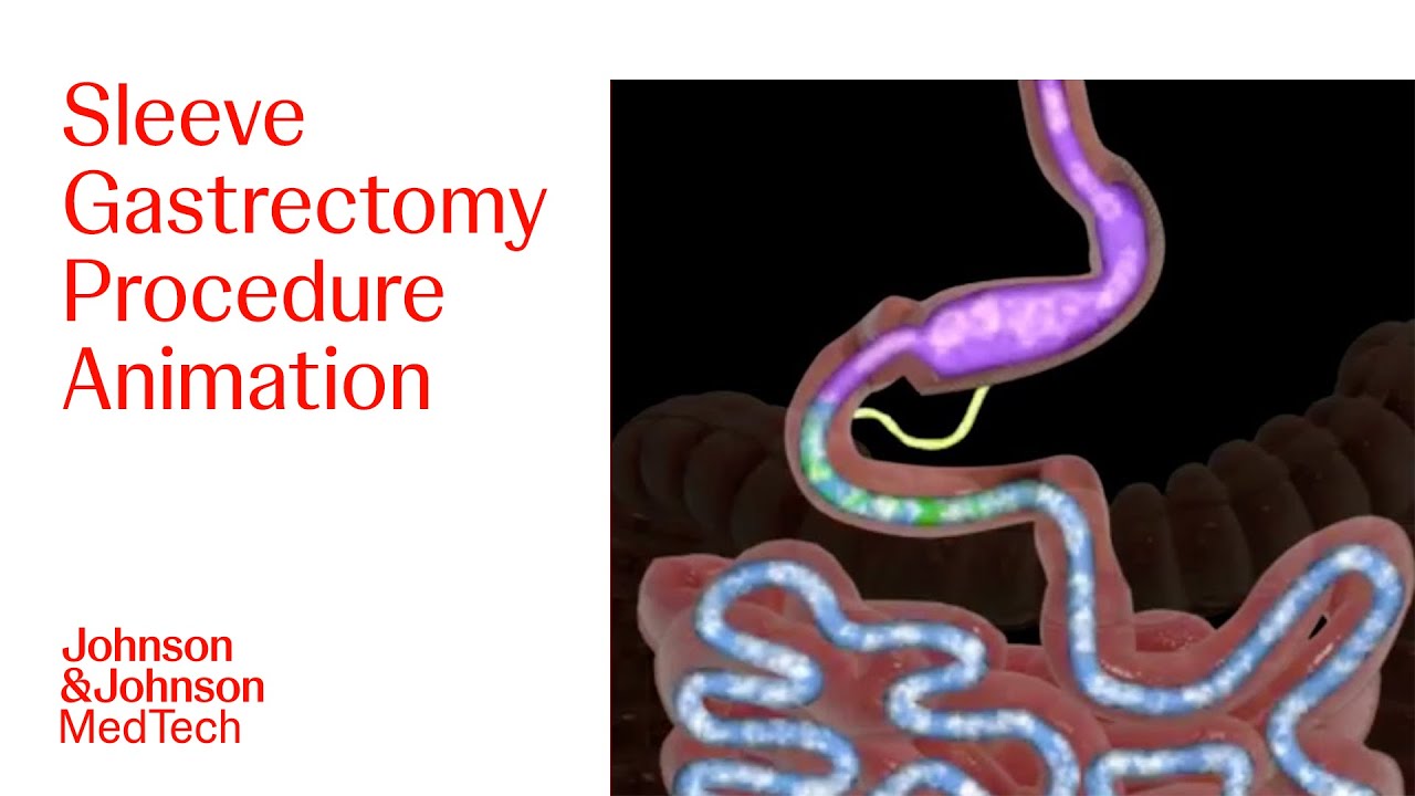 Sleeve Gastrectomy Procedure Animation | J&J MedTech