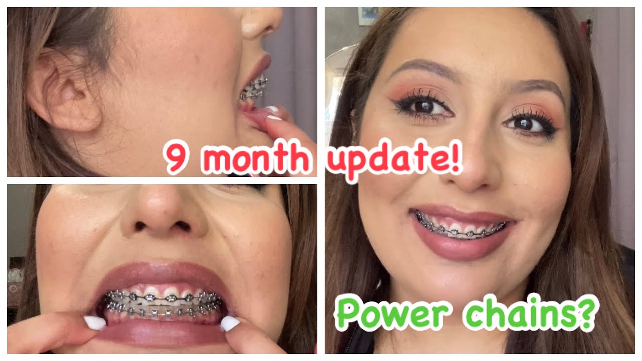 9 Month Braces Update - Mid Journey! - Damon Braces - No Extractions for Overbite/ Overjet