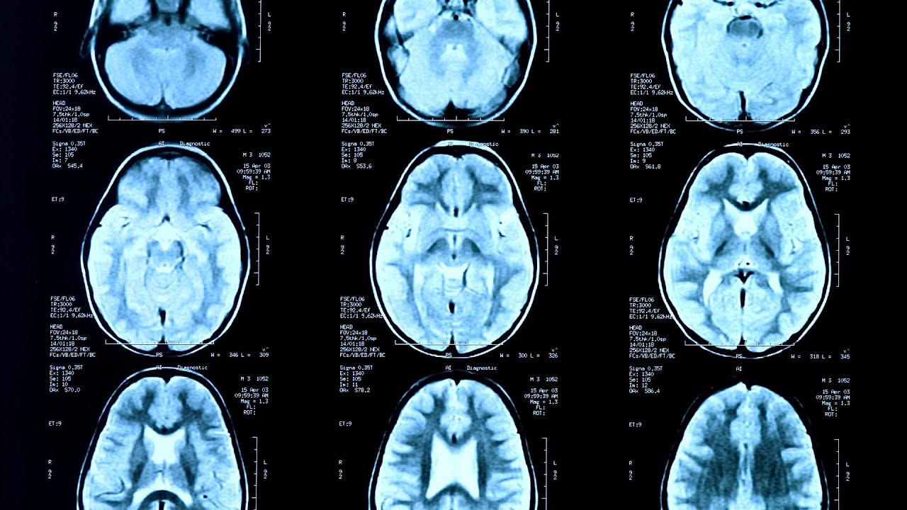 Seizures vs. Epilepsy | Epilepsy