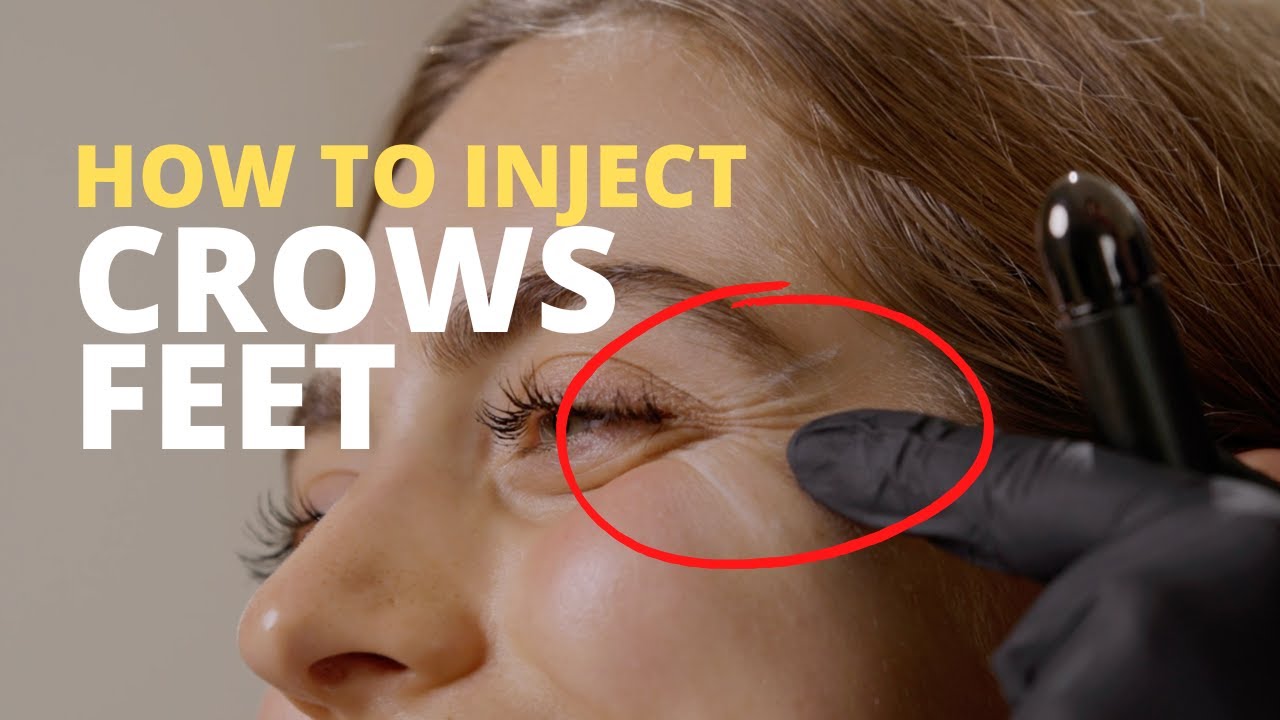 How BEST method to treat crows feet: step-by-step guide