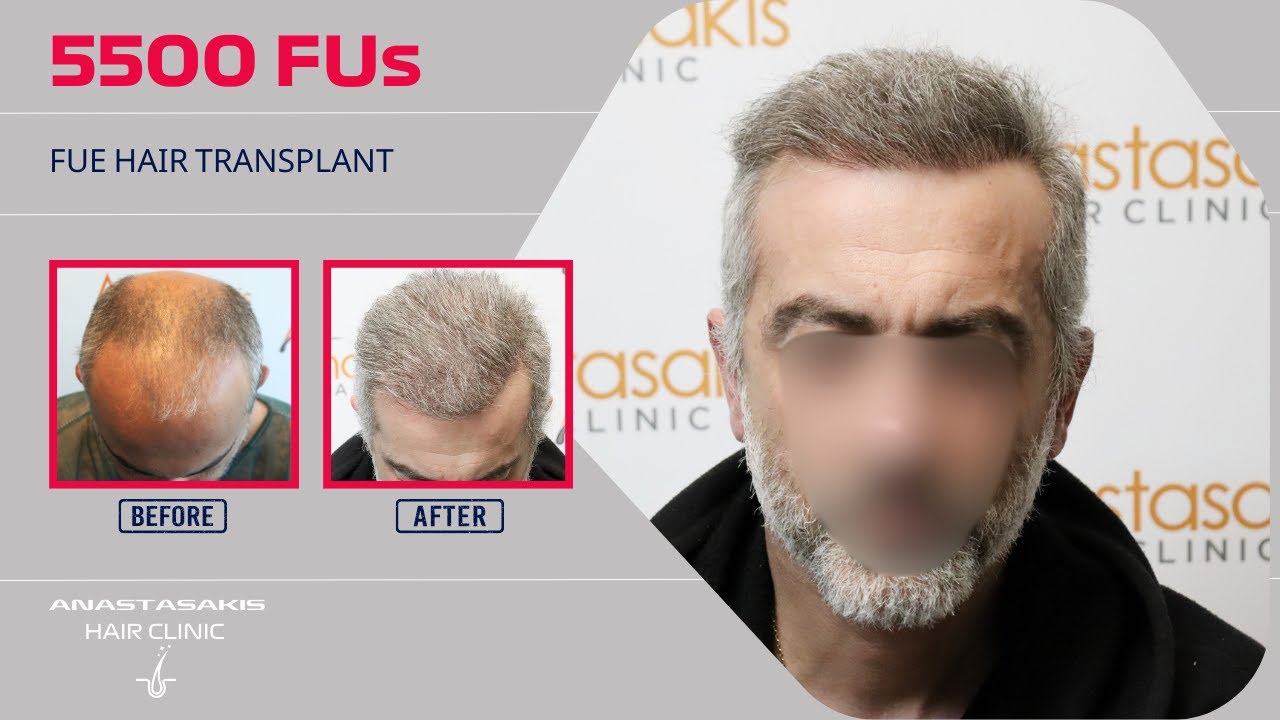 🔥 Από στάδιο 6 σε γεμάτο μαλλί! 5.300 τριχοθυλάκια & το αποτέλεσμα ΕΚΠΛΗΚΤΙΚΟ! 💇‍♂️✨ |  case #376a